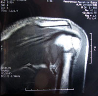 MRI Scan of a shoulder